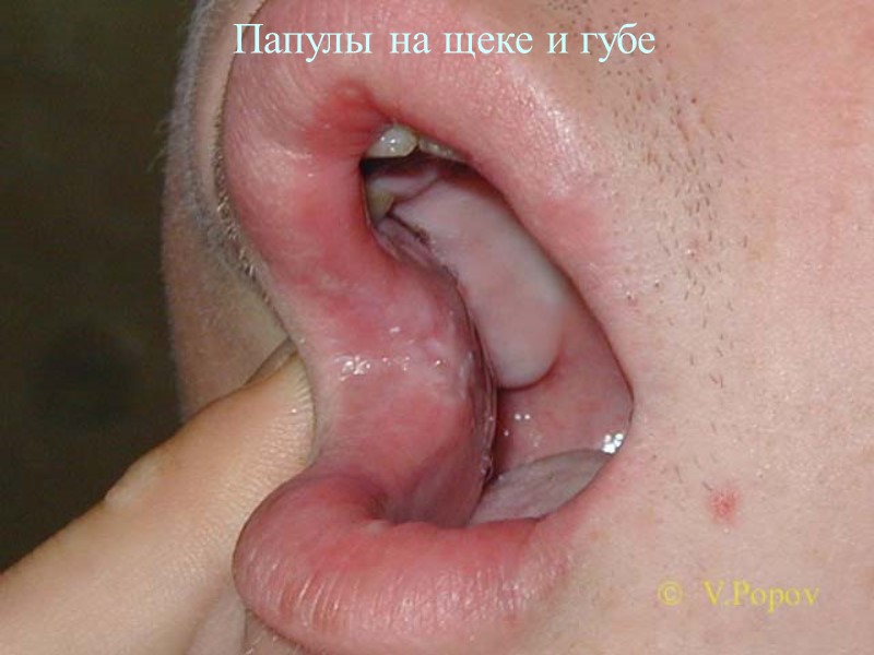 Папулы на щеке и губе